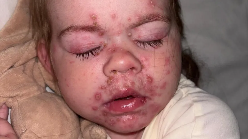 Children offered chickenpox vaccine on NHS