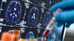 Alzheimer&#039;s drugs that slow the disease will not be made available on the NHS