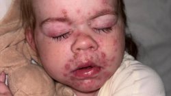 Children offered chickenpox vaccine on NHS