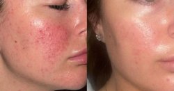 Teens &#039;more confident&#039; after using &#039;life-changing&#039; skincare that helps spot-prone skin
