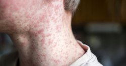 Crisis in Spain as tourist hotspots hit with infectious disease outbreak