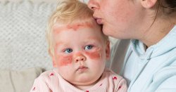 Scottish baby severely sunburned under factor 50 cream on overcast day, mum warns