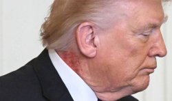 Donald Trump health fears explode as sickening rash spotted on President's neck