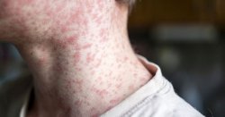 Cases of Victorian-era disease surge in England as 'vital protection' plea is<b class='text-danger'>sued</b>